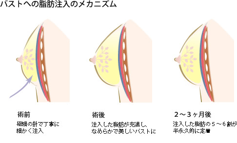 脂肪注入による豊胸術の治療法