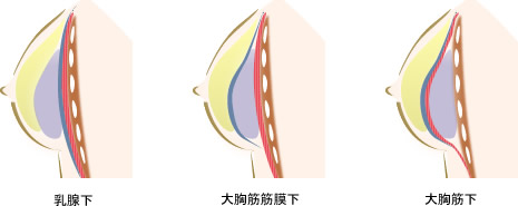 人工乳腺法による豊胸術の治療法