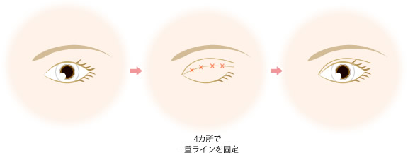 ダブルノット法